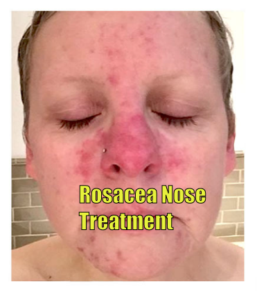 rosacea nose treatment