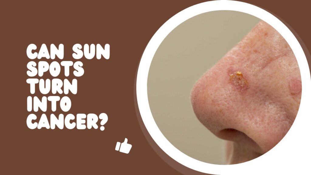 Can Sun Spots Turn Into Cancer