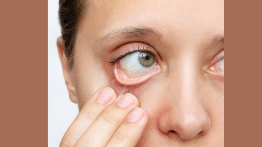 Are Dark Eyelids A Sign Of Anemia